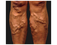 Varicose Veins Treatments Legs