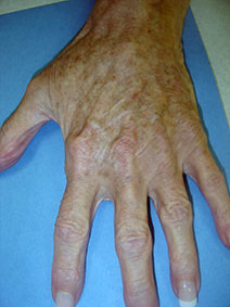 Vanish Vein Laser Center Naples Florida Hand Vein Treatment