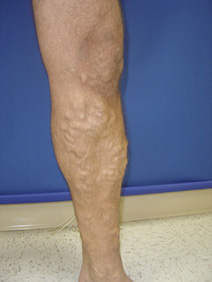 laser ablation of severe varicose veins
