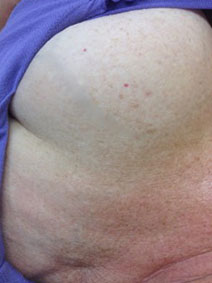 Vanish Vein Laser Center Breast Vein Treatment