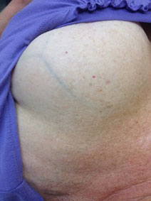 Vanish Vein Laser Center Breast Vein Treatment