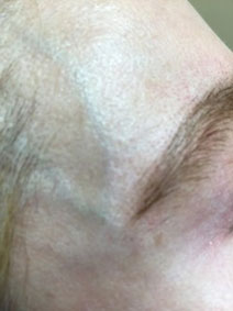 Vanish Vein Laser Center Facial Vein Treatment