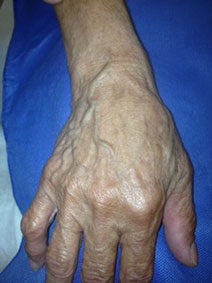 Vanish Vein Hand Vein Treatment