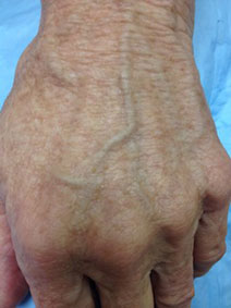 Vanish Vein Hand Vein Treatment