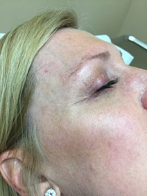 Dr John Landi Vanish Vein Laser Center Facial Vein Treatment Pictures