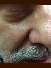 Vanish Vein and Laser Center Naples Florida Nasal Vein Treatment Picture