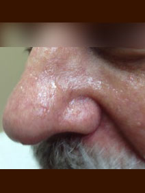 Vanish Vein and Laser Center Naples Florida Nasal Vein Treatment Picture