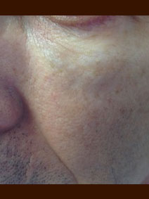 Naples Florida Vanish Vein and Laser Center Facial Vein Treatment Picture