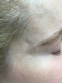 Naples Florida Facial Vein Treatment Picture