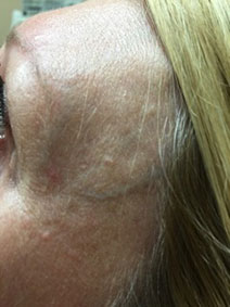 Dr John Landi Vanish Vein Laser Center Facial Vein Treatment Pictures