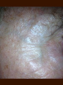 Naples Florida Vanish Vein and Laser Center Facial Vein Treatment Picture