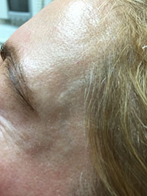 Naples Florida Facial Vein Treatment Picture