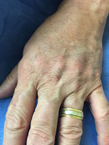 Hand Vein Treatment with filler on male patient - Vanish Vein and Laser Center Naples Florida