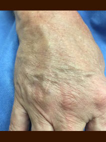 Hand Vein Treatment with filler on male patient - Vanish Vein and Laser Center Naples Florida