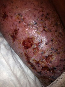 Venous Stasis Ulcer Treatment Picture Vanish Vein Naples Florida