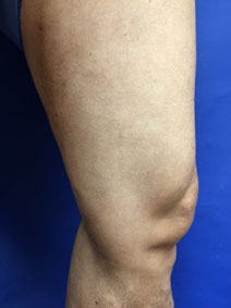 Vanish Vein and Laser Center Naples Leg Varicose Vein Treatment