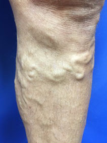 Vanish Vein and Laser Center Naples Leg Varicose Vein Treatment