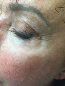 Naples Florida Vanish Vein and Laser Center Under Eye Vein Treatment