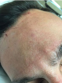 Vanish Vein and Laser Center Naples Florida Forehead Vein Treatment Picture