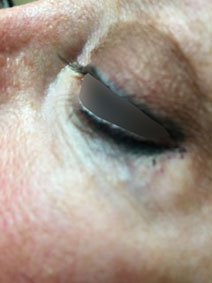 Naples Florida Vanish Vein and Laser Center Under Eye Vein Treatment