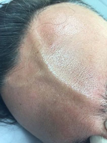 Vanish Vein and Laser Center Naples Florida Forehead Vein Treatment Picture