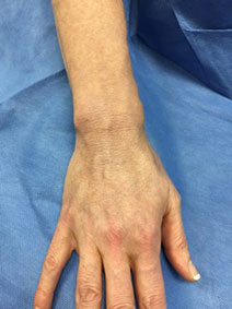 Vanish Vein Laser Center Hand Vein Treatment Picture