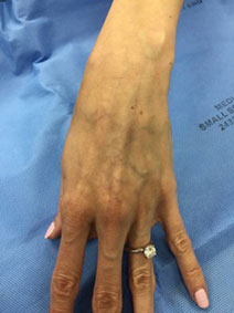 Hand Vein Treatment Picture Vanish Vein and Laser Center Naples Florida