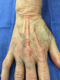 Naples Vanish Vein and Laser Center Hand Vein Treatment Pictures