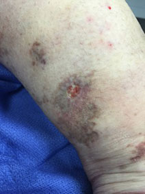 Naples Florida Vanish Vein Laser Center Venous Leg Ulcer Treatment Pictures