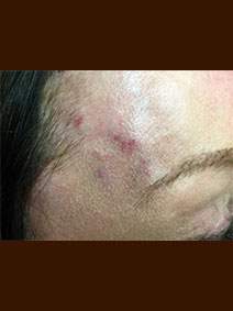 Face Forehead Vein Treatment Picture Vanish Vein and Laser Center Naples Florida