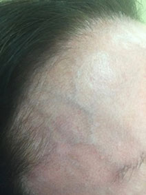 Face Forehead Vein Treatment Picture Vanish Vein and Laser Center Naples Florida