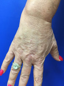 Vanish Vein and Laser Center Naples Florida Hand Vein Treatment