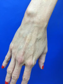 Vanish Vein and Laser Center Naples Florida Hand Vein Treatment