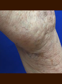Leg Spider Veins Treatment Photo Vanish Vein and Laser Center Naples Florida