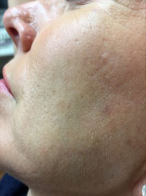 Facial Veins Treatment by Vanish Vein and Laser Center Naples Florida