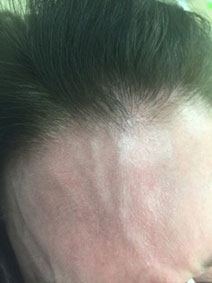 Vanish Vein Naples FL Face Forehead Vein Treatment