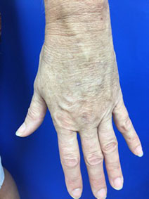 Unsightly Hand Veins Treatment by Vanish Vein and Laser Center Naples Florida