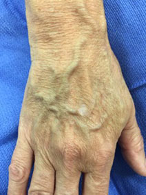Unsightly Hand Veins Treatment by Vanish Vein and Laser Center Naples Florida