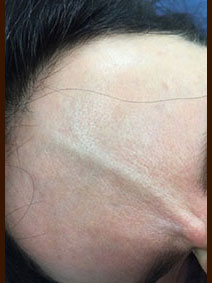 Before and After Forehead Veins Sclerotherapy Treatment Vanish Vein Naples Florida