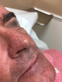 Vanish Vein and Laser Center Nasal Veins treatment Before and After Pic