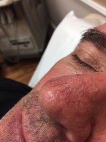 Vanish Vein and Laser Center Nasal Veins treatment Before and After Pic