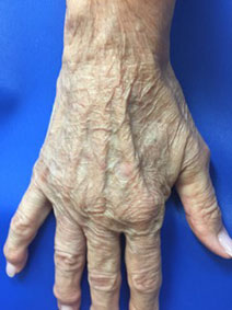 Naples Florida Hand Vein Treatment Before and After Pictures