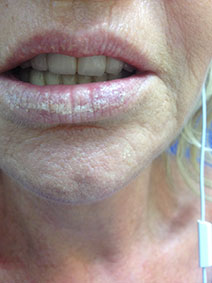 Naples Florida Vanish Vein Lower Lip Hemangioma Laser Removal Picture