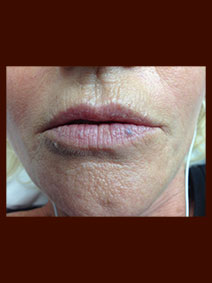 Naples Florida Vanish Vein Lower Lip Hemangioma Laser Removal Picture