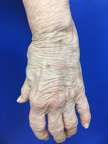 Naples Florida Hand Varicose Vein Treatment Vanish Vein and Laser Center