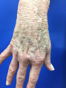 Naples Florida Hand Varicose Vein Treatment Vanish Vein and Laser Center