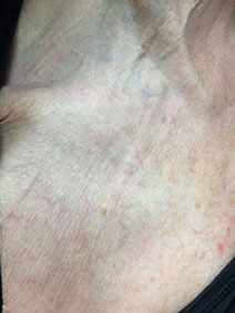 Chest area varicose vein treatment results picture vanish vein naples florida