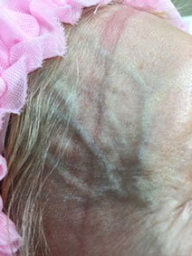 Forehead varicose vein remove results picture naples florida