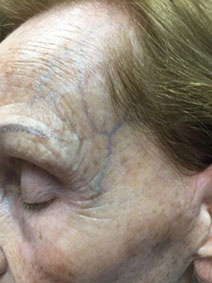 Forehead varicose vein remove results picture naples florida