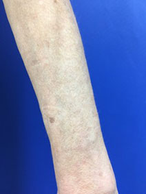 Arm Varicose Vein Removal by Vanish Vein and Laser Center Naples Florida